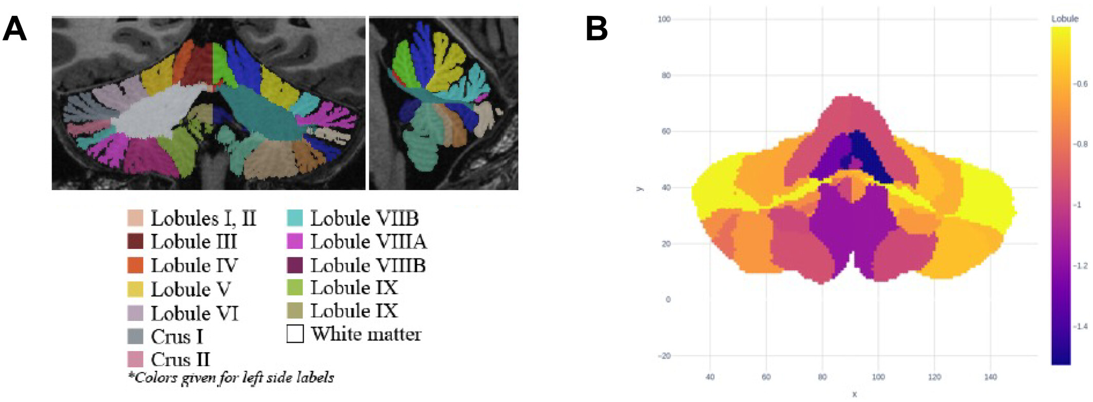 Histiocytosis article
